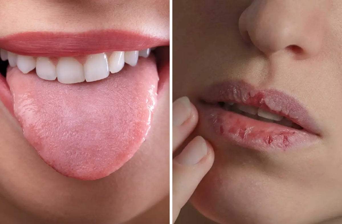 melanotic macule Melanotic macule on the lower lip