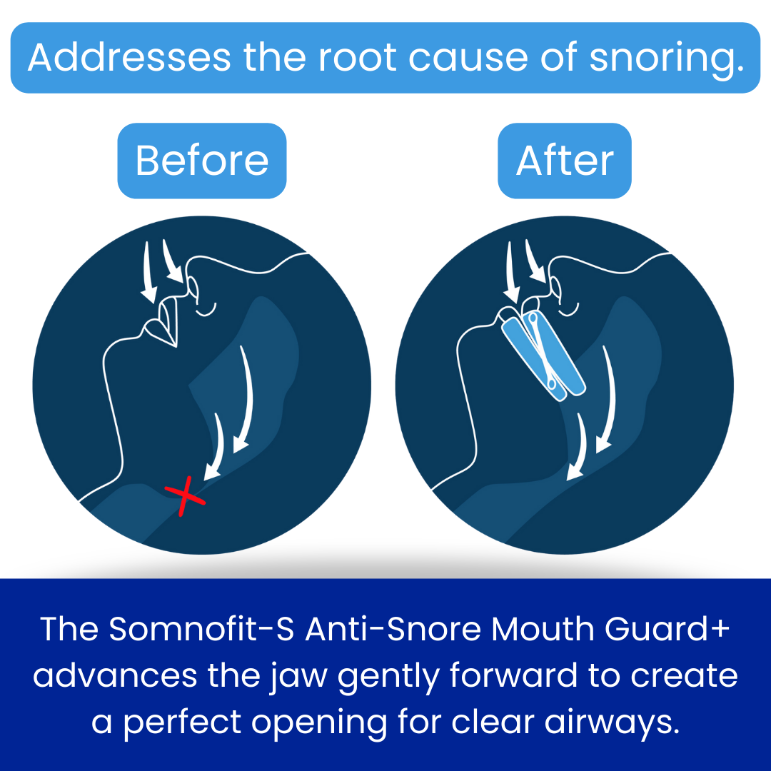 Somnofit-S Anti-Snore Mouth Guard+ by SnoreLessNow