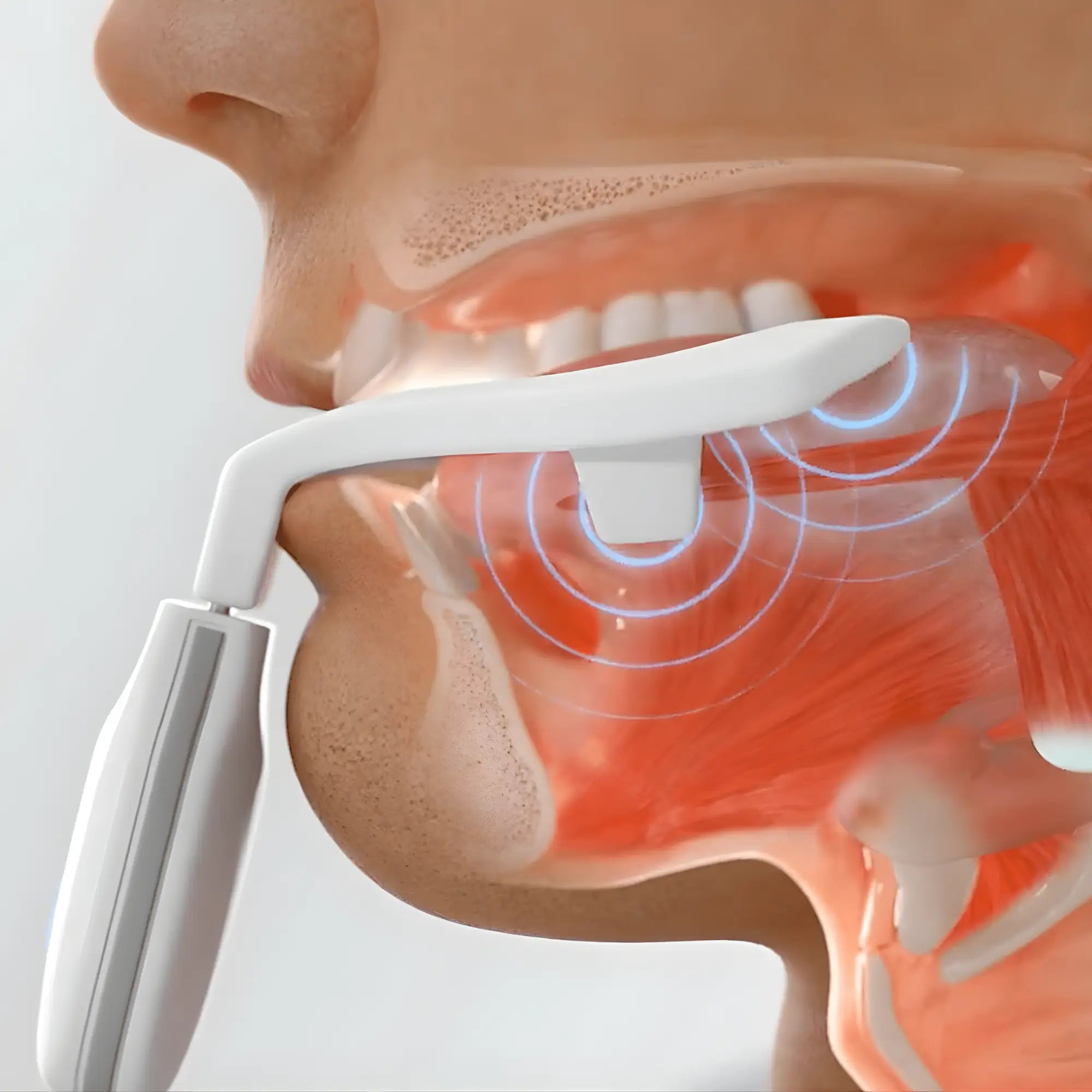 Diagram of how eXciteOSA works, stimulating the tongue and airway muscles to keep the airway open during sleep